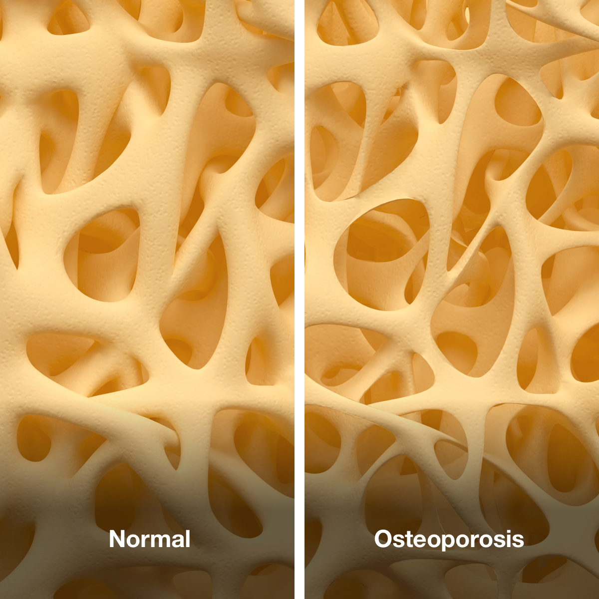 An image of healthy bones on the left, and bones affected by osteoporosis on the right