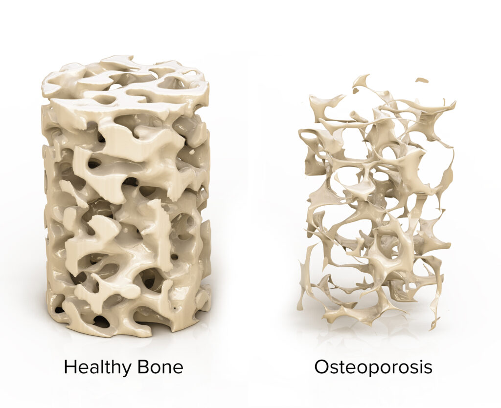An image of healthy bones on the left, and bones affected by osteoporosis on the right